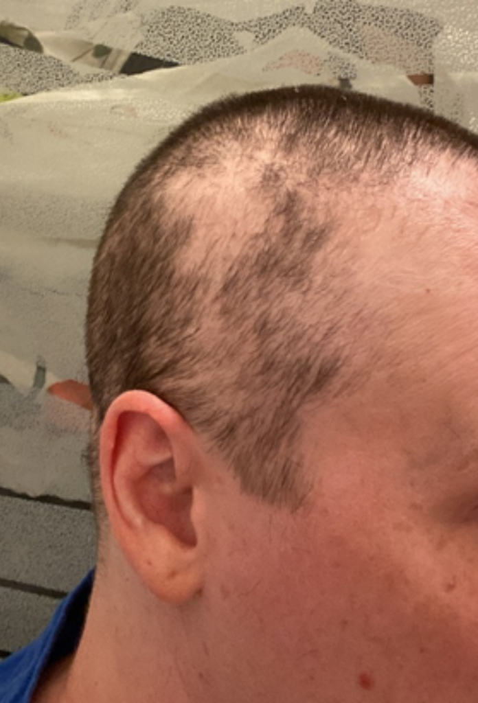 Emma's hair loss experience